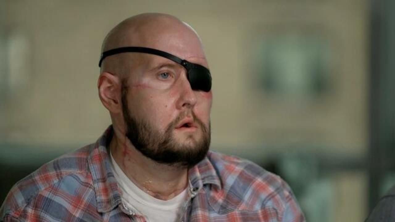 Мужчине, потерявшему половину лица после удара током, впервые в истории пересадили целый глаз